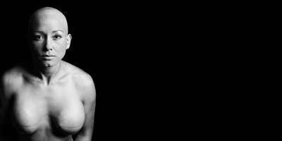 Fine Art Photograph of Double Mastectomy Scars
